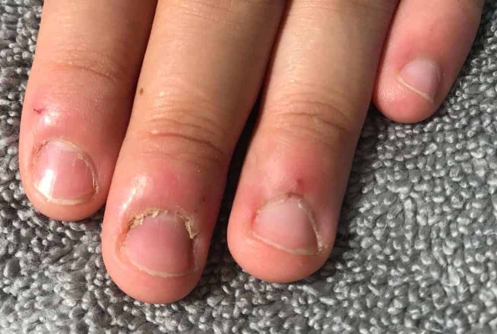 Why Remove Cuticles?