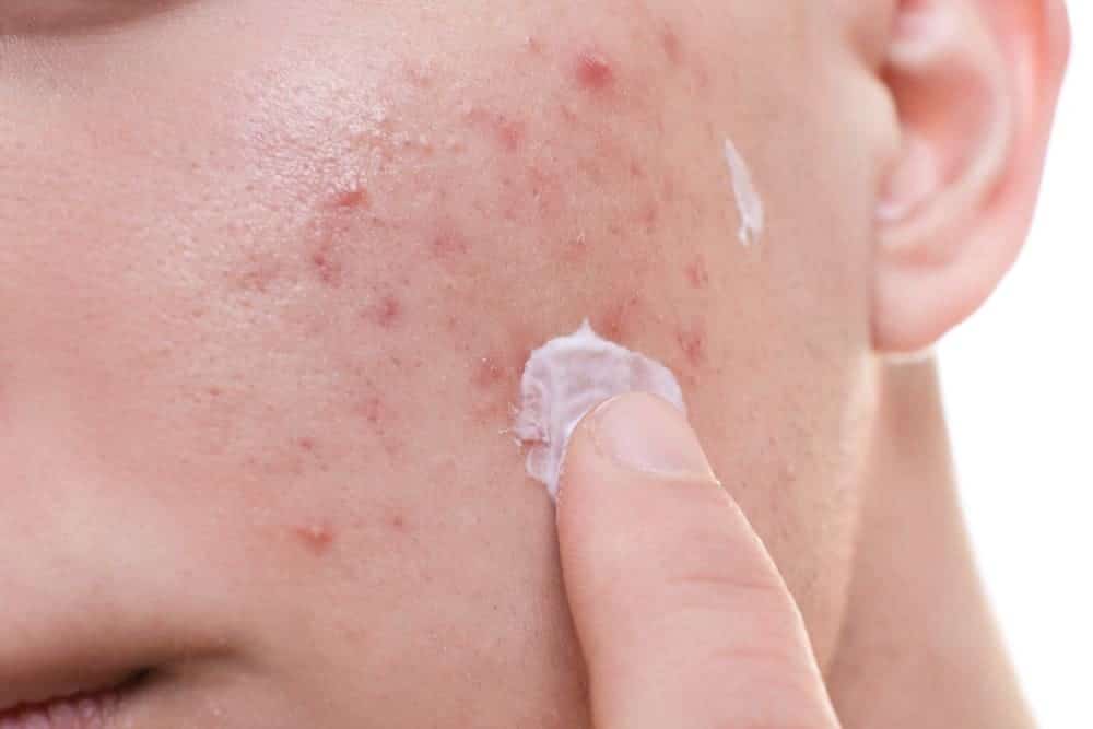 Benefits of Using Scar Removal Cream